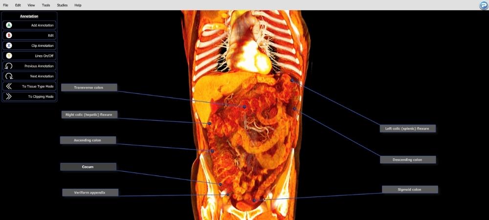 Dissection of the colon with BodyViz real patient virtual dissection app