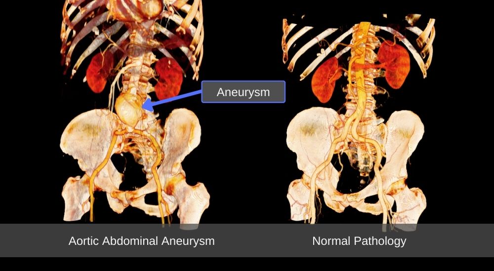 Aortic Abdominal Aneurysm Comparison with 3D visualizations from the BodyViz Virtual Dissection App