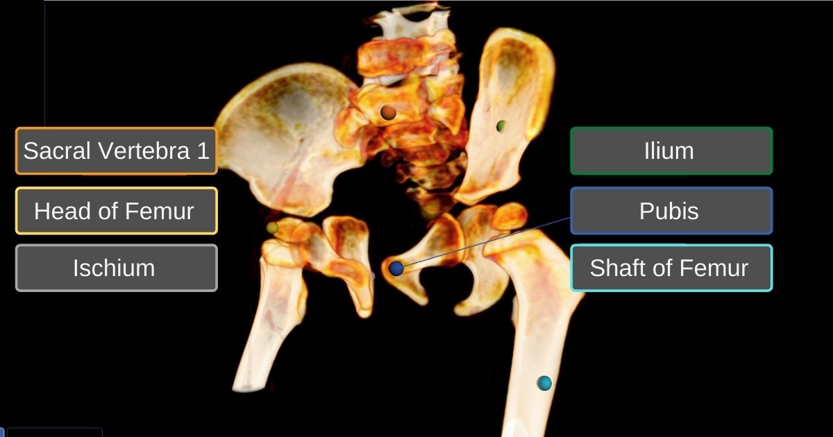 Unfused Anatomy of the Sacral Vertebra, head of the femur, ischium, illium, pubis, shaft of the femur