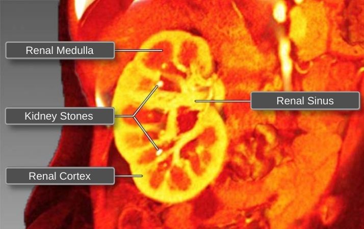 Renal Medulla, Cortex, and Sinus with Kidney Stones