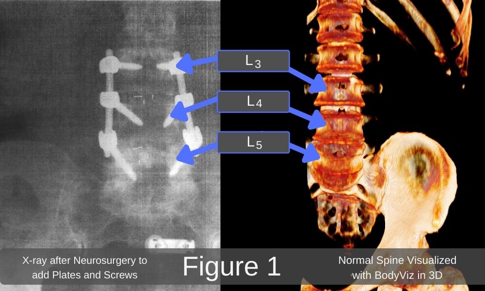 3d image of lumbar spine and sciatica