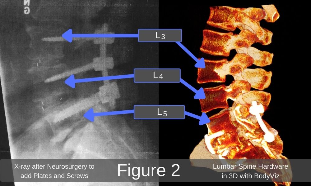 X-ray of lumbar spine and 3D anatomy comparison