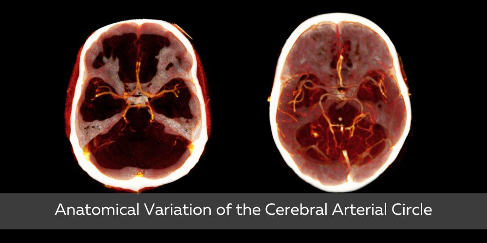 Anatomical Variation of the Circle of Willis