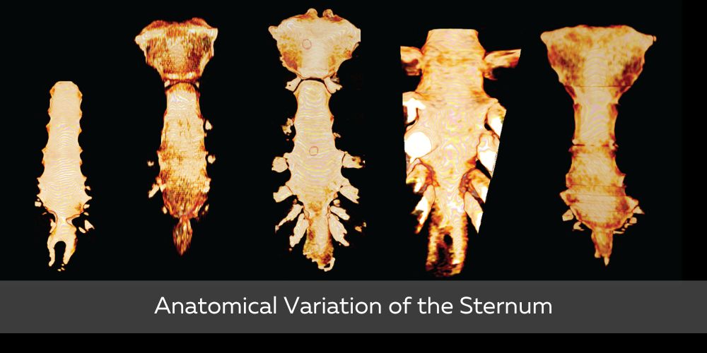 Anatomical Variations in the xiphoid process of the sternum
