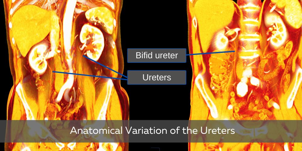 Anatomical Variations in the anatomy of the ureter